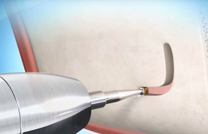 Gáspár Dental implantáció sinus lift arcüreg emelés