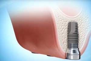 Gáspár Dental implantáció sinus lift arcüreg emelés szájsebészet