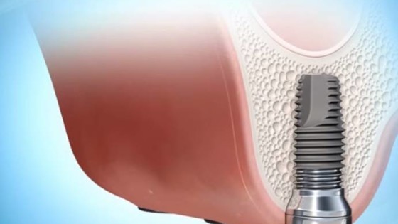 Gáspár Dental implantáció sinus lift arcüreg emelés szájsebészet