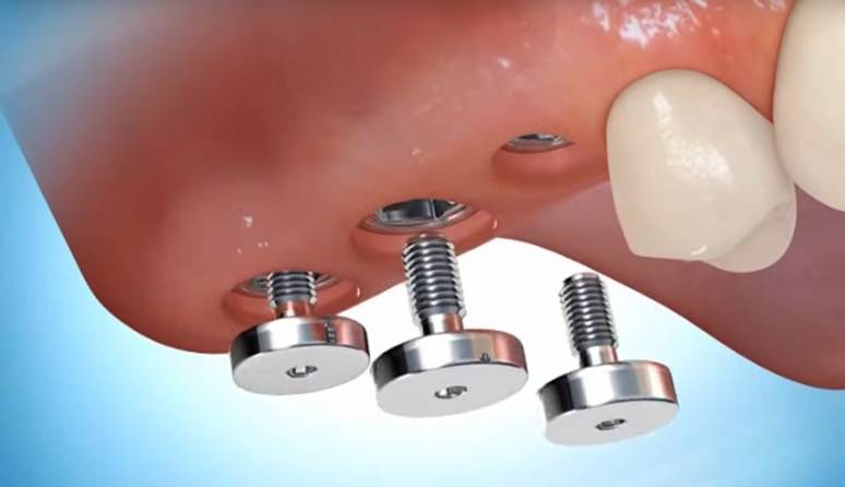 Gáspár Dental implantátum behelyezés implantáció szájsebészet