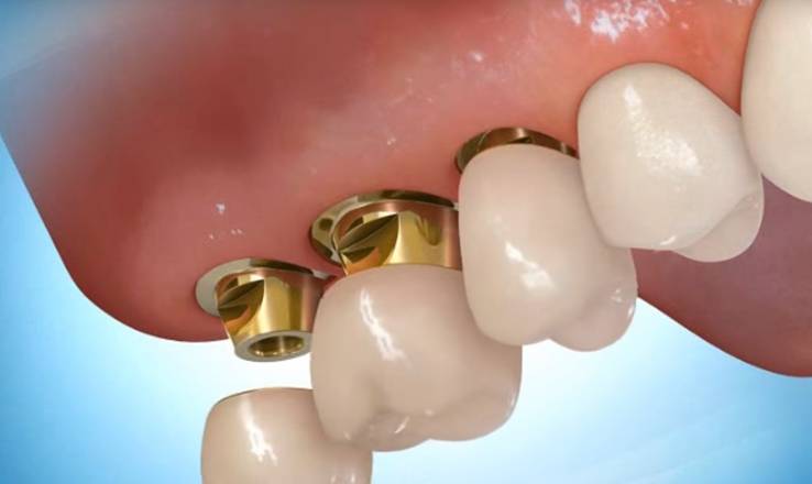 Gáspár Dental implantáció Implantátumokra épülő fémvázas és fémmentes pótlások szájsebészet