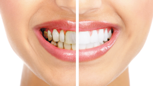 Gáspár Dental mosolykorrekciós kezelések esztétikai fogászat