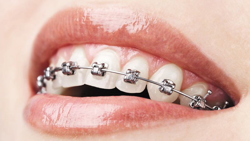Gáspár Dental fogszabályzás konzultáció tervezés karbantartás