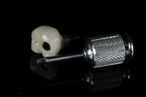 korona készítés fogkorona cirkón korona gáspár dental