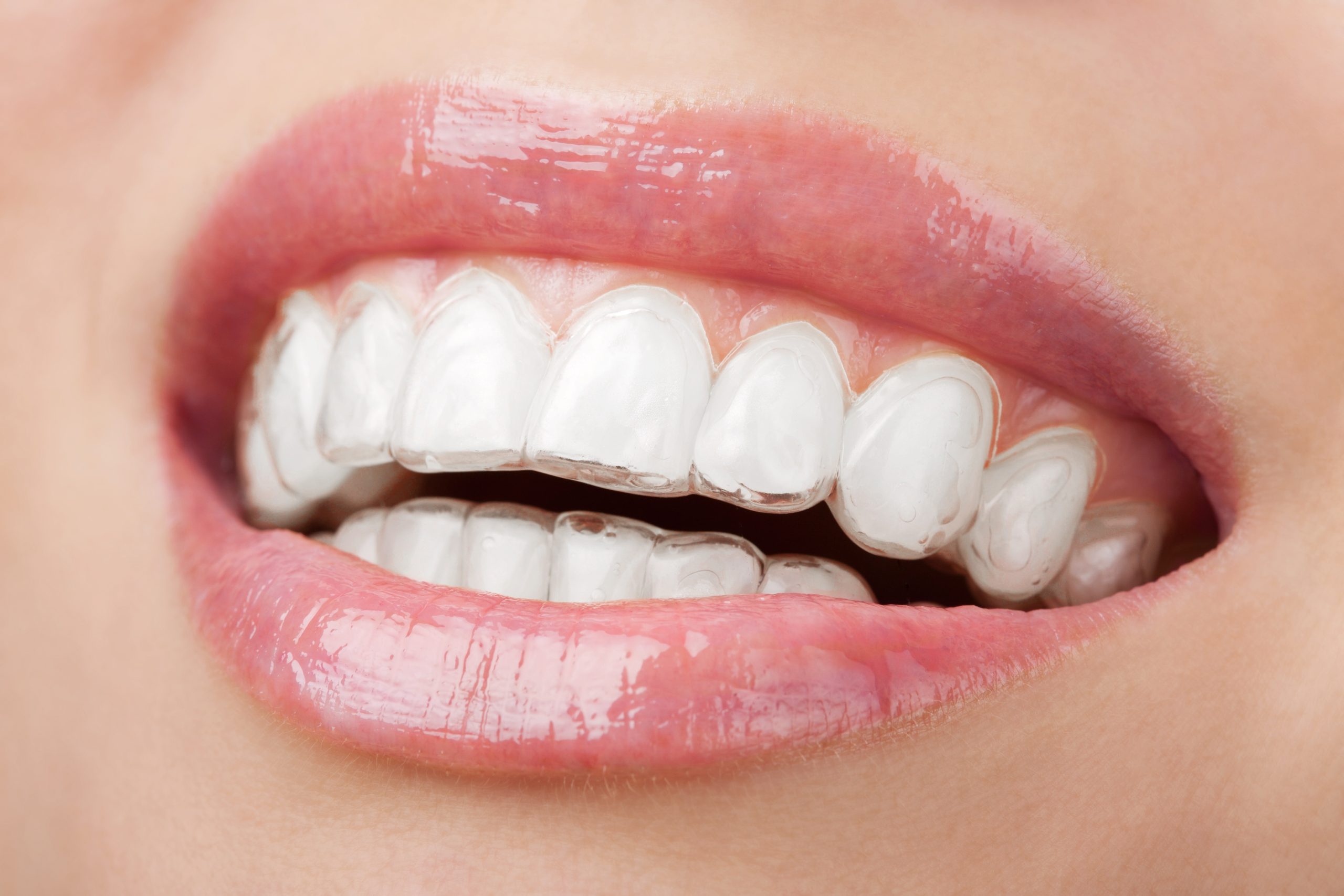 láthatatlan fogszabályotó gaspar dental