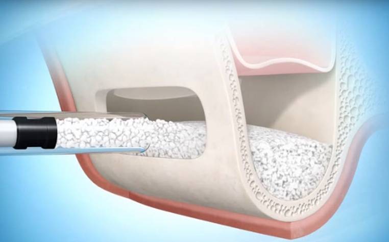 Az implantátum beültetéshez csontalakítás és csontpótlás módszerei