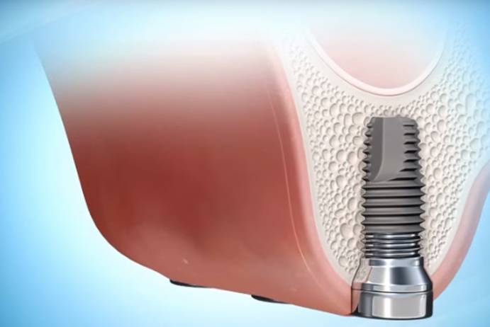 Implantátum beültetéshez használatos diagnosztika és tervezés