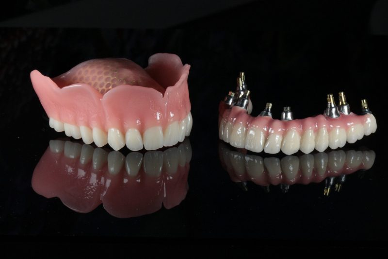 Implantátumra épülő pótlások – Merjen mosolyogni teljes Önbizalommal!