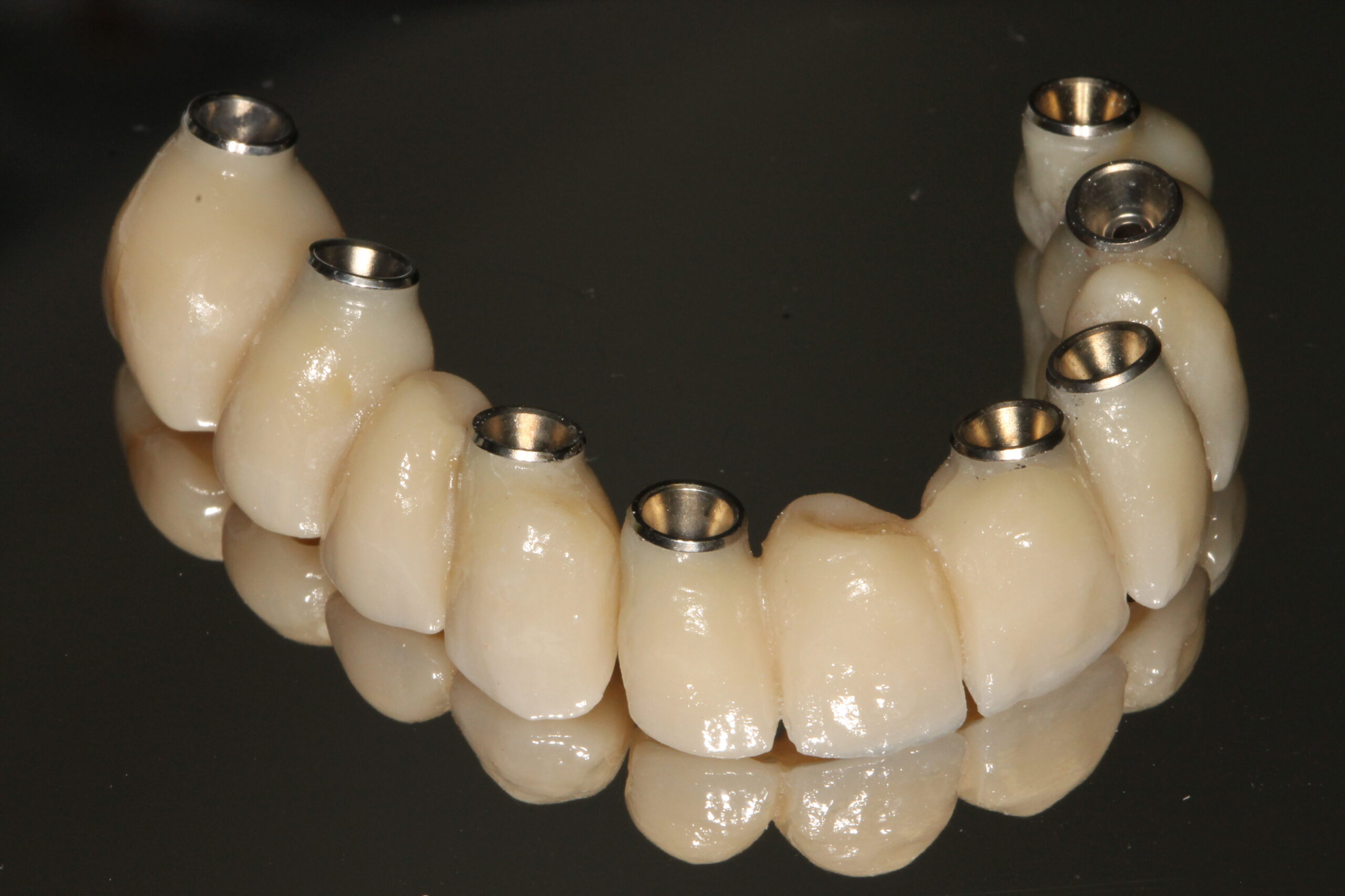 Implantátum műgyökér fogsor körhíd Dr Tóth-Gáspár Máté Gáspár Dental Gaspar Medical Center